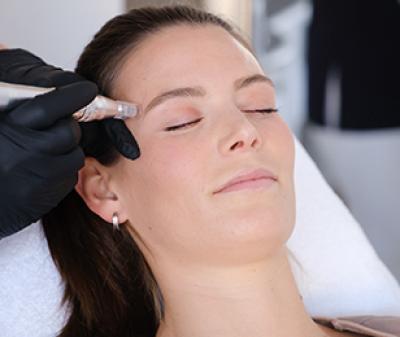 Microneedling inklusive Intensivpeeling auf Säurebasis