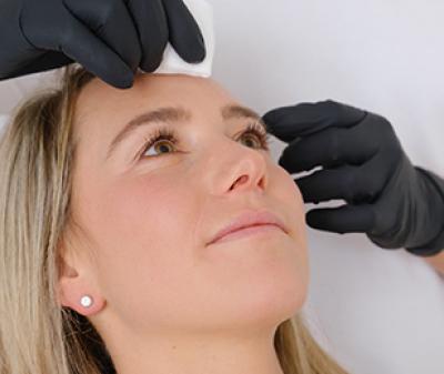 Botolinumtoxin-Behandlung - Zornesfalte und Stirn